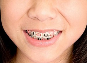 brace