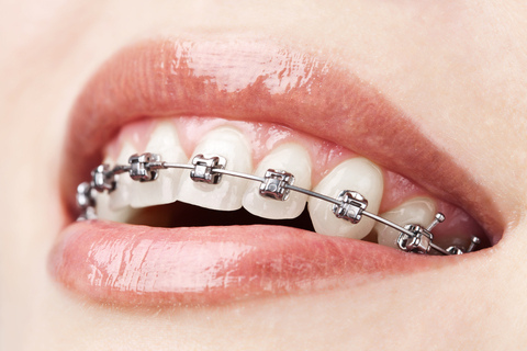 ortho-helpful-site-braces.jpg