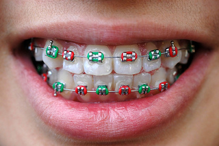 ortho-mouth-coloredbands.jpg