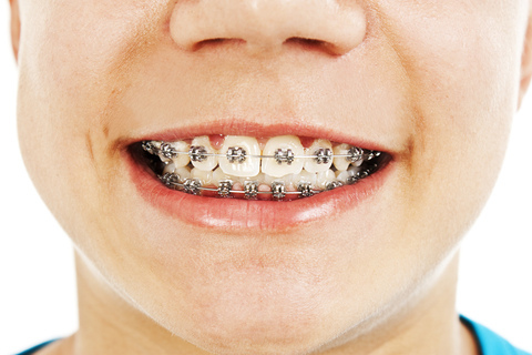 ortho-boybraces-closeup.jpg