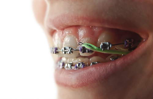 ortho-boy-elastics.jpg